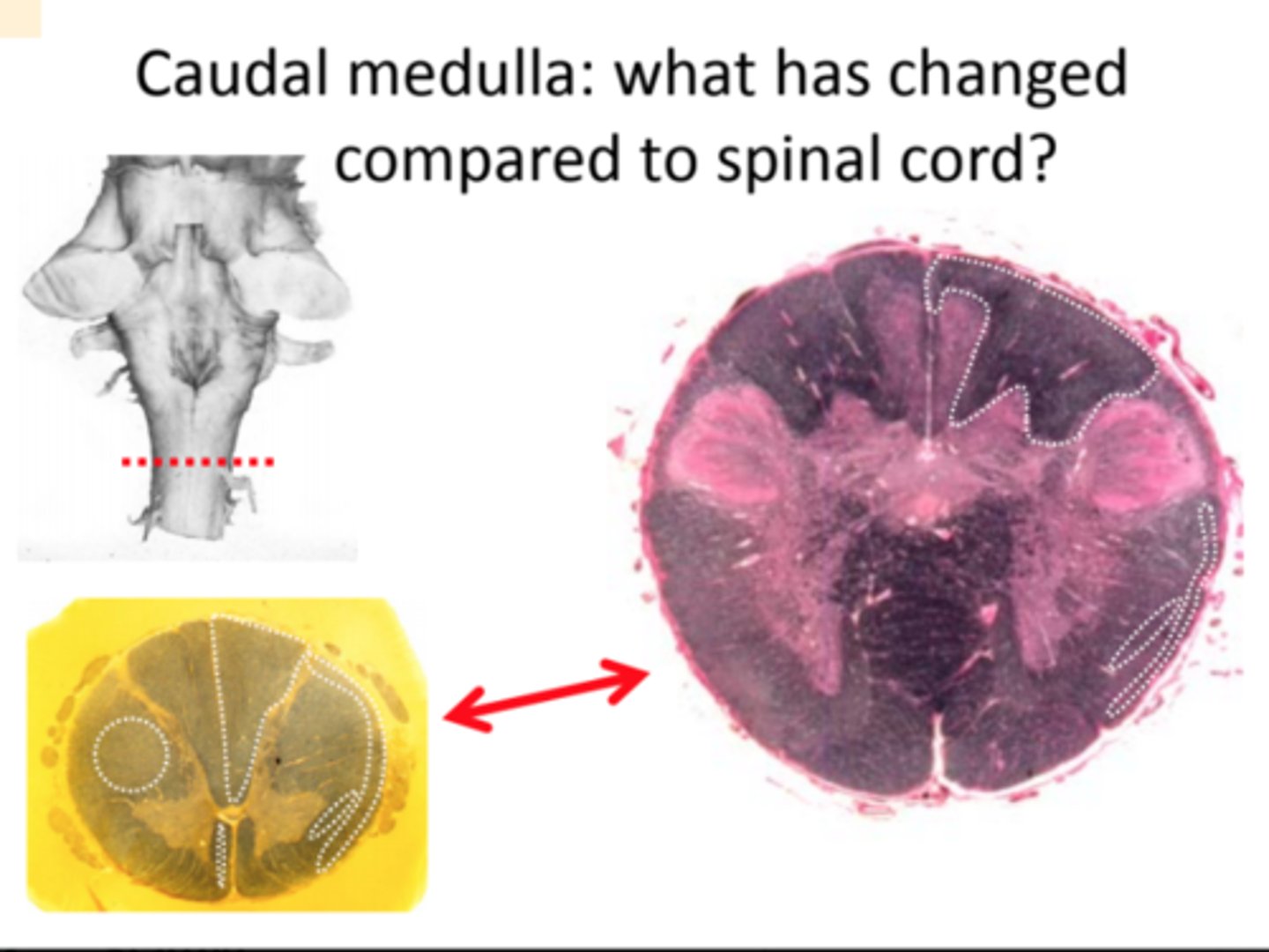 <p>- Corticospinal tract looks like it is gone<br>- Dorsal horn is much bigger<br>- Ventral horn is much smaller<br>- More fibers between ventral horns (pyramidal decussation)<br>- Dorsal columns present but not growing within them (somatosensory fibers are synapsing onto gracile and cuneate nuclei<br>- Spinothalamic tract and spinocerebellar tract unchanged</p>
