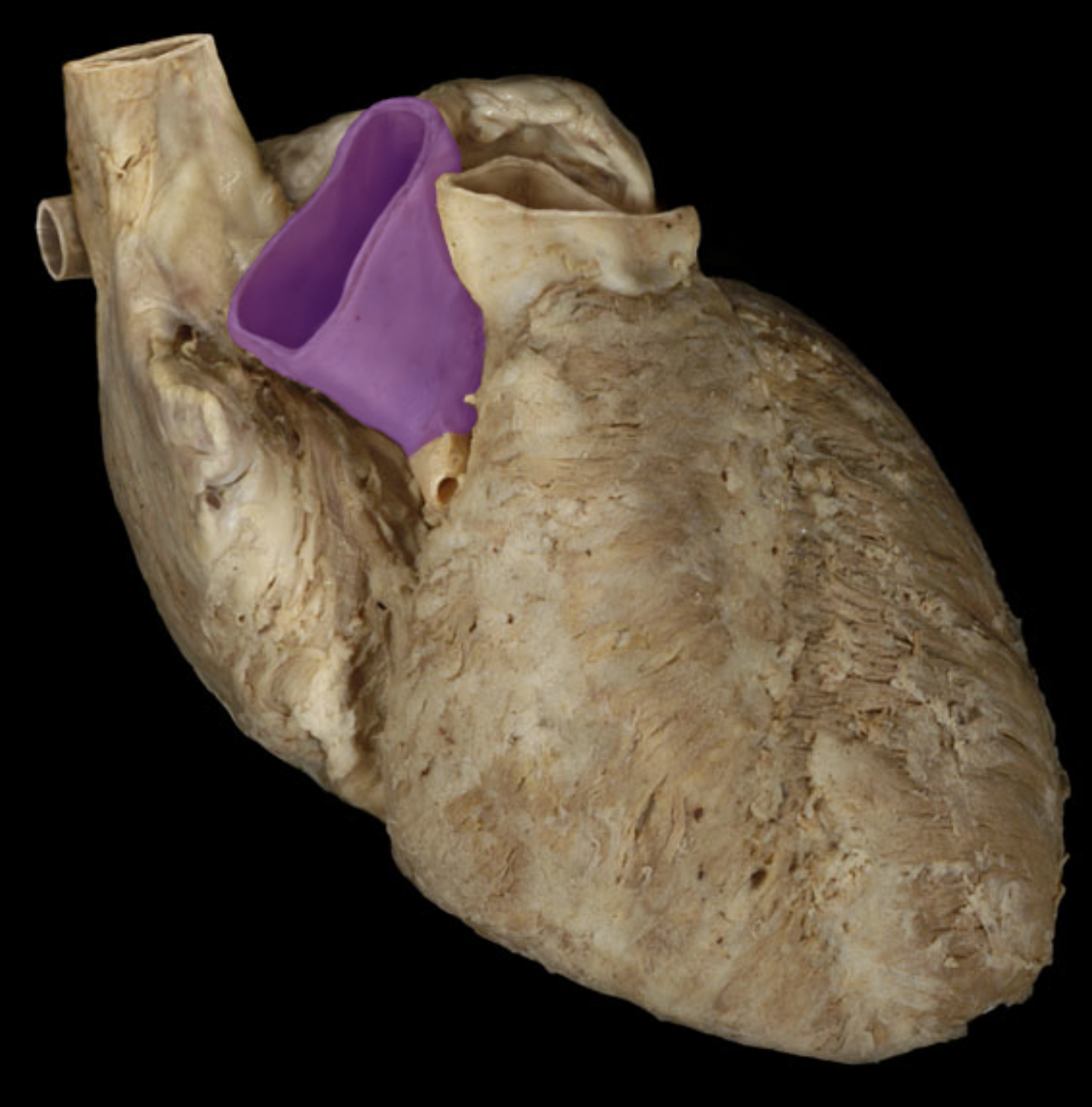 <p>Ascending aorta</p>