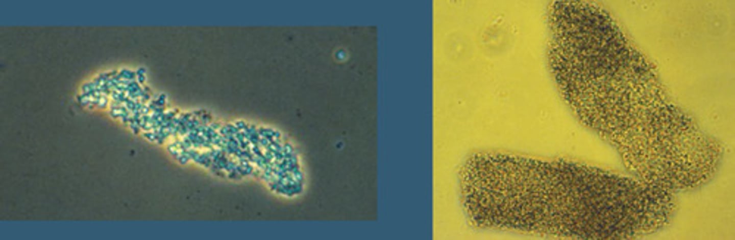 <p>Broad, fine or coarse</p><p>Composed of degraded cellular products and serum proteins (Albumin, IgG, Transferrin, etc.)</p><p>Non-specific, Indicative of Renal Parenchymal Disease; ATN</p>
