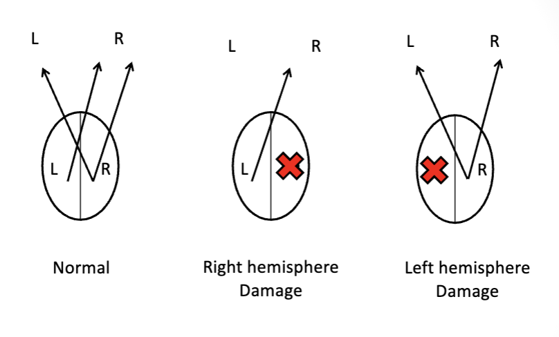 <p>higher cortical funcions: </p><p><strong><u>***know the examples provided for spatial relations dysfunction (e.g., position in space, depth/distance, etc.). damage to which area of the brain will likely cause these deficits? what would you clinically see during engagement in activity/occupation with each of these deficits?</u></strong></p><p><strong><u>***know the neglect syndromes (e.g., unilateral spatial neglect; unilateral body neglect). damage to what areas of the brain will likely cause neglect syndromes? why is left unilateral spatial neglect more common than right unilateral visual spatial neglect? what would you see clinically during engagement in activity/occupation with each of these deficits? </u></strong></p><p>differences in attentional processing of the brain</p>