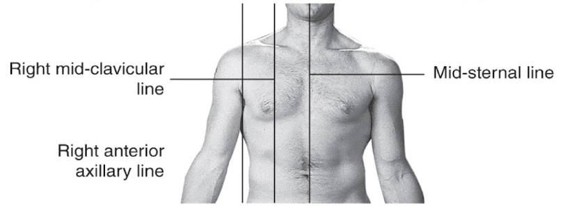 <p>Vertical line passing through the <strong>midpoint of the clavicle</strong> on the anterior torso</p>