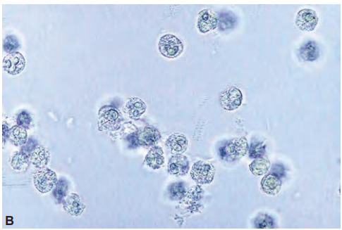 <p><span style="font-family: MyriadPro-Light;">Notice the multilobed nucleoli (</span><span style="font-family: Symbol;">×</span><span style="font-family: MyriadPro-Light;">400).</span></p>
