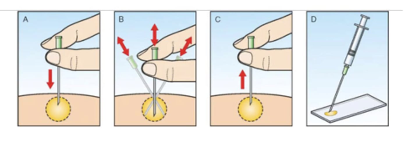 <p>What fine needle aspirate technique is this?</p>