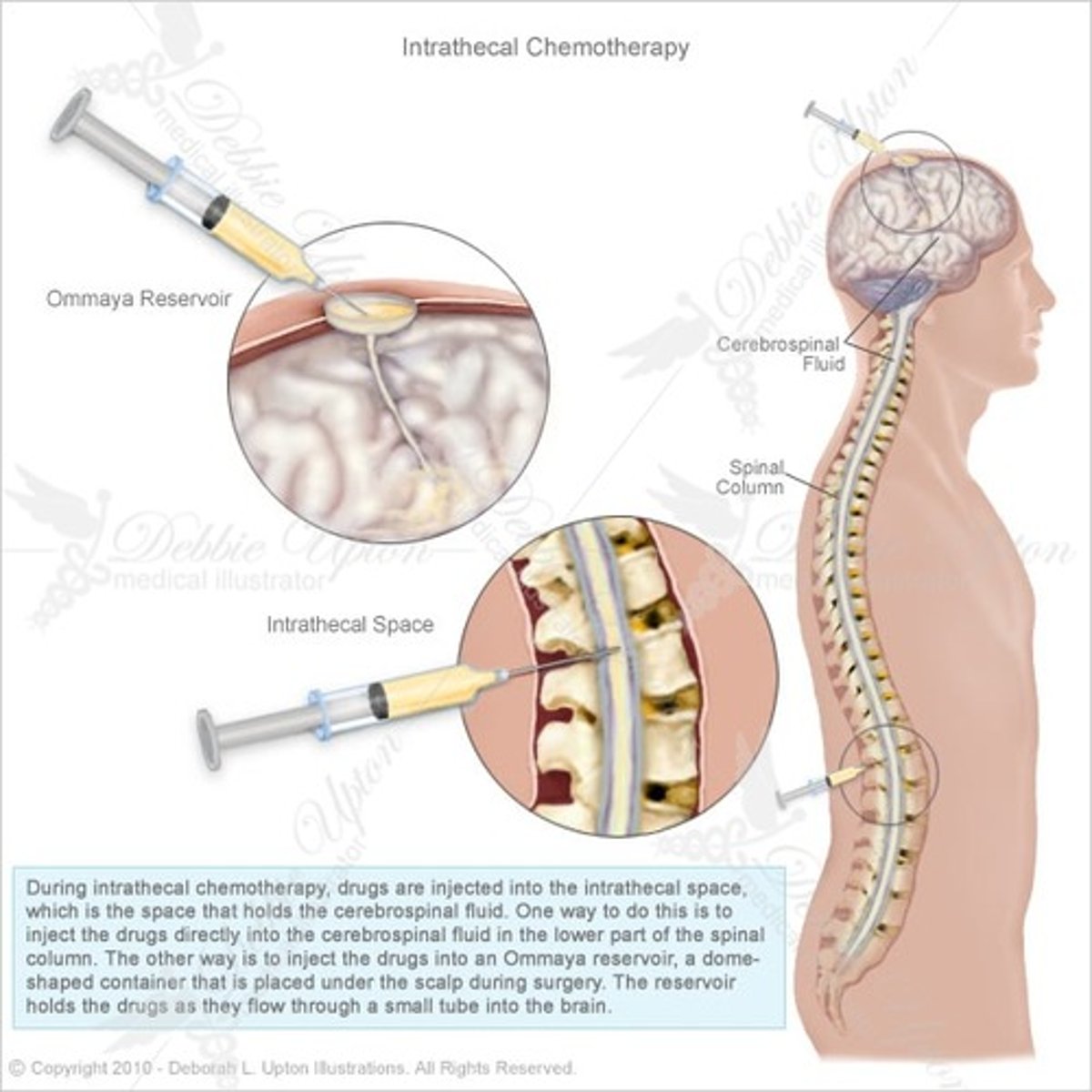 <p>abrupt stop may cause:</p><p>- rebound muscle splasicity FOLLOWED BY FEVER</p><p>- muscle damage + hyperactive --&gt; rhabdomylosis (toxins produced) which cause organ failure</p>