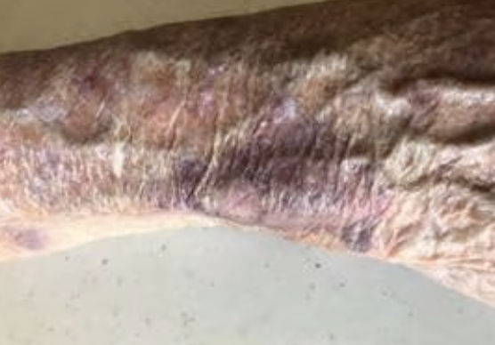 <p>what type of vascular skin lesion is this?</p>