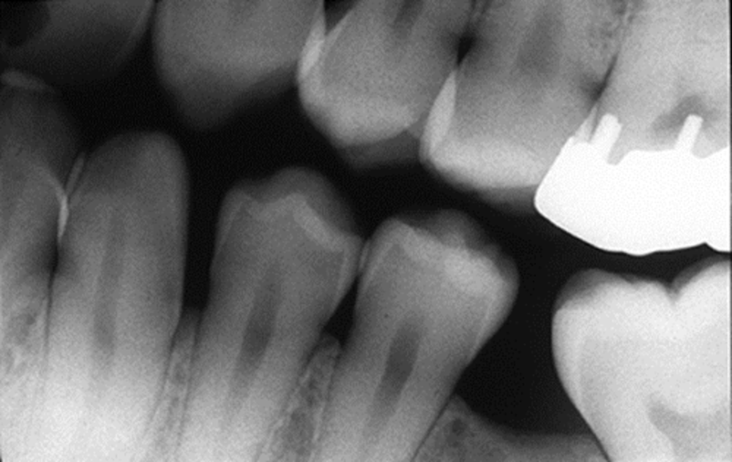 <p>prior to composite filling</p>