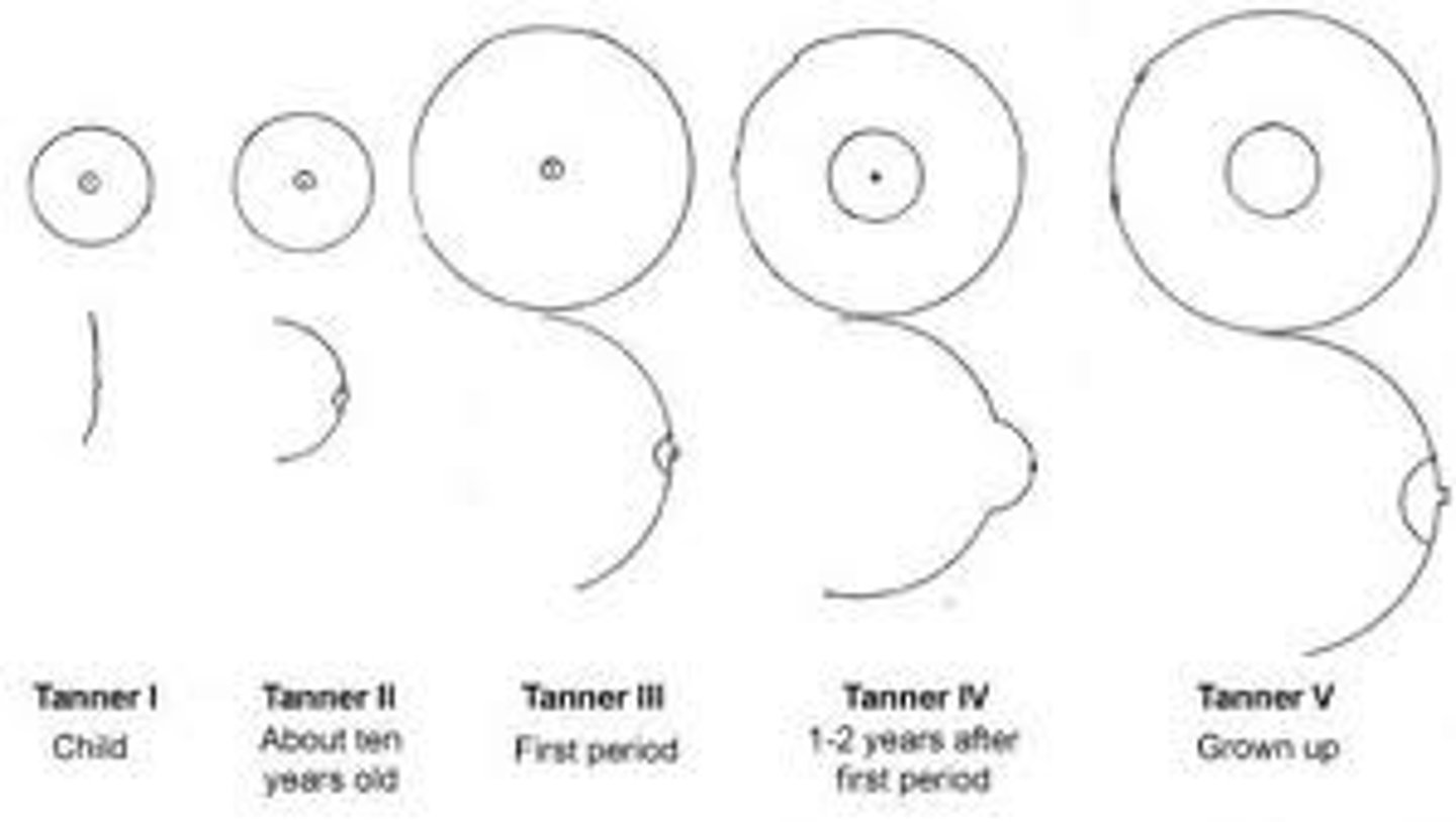 <p>Stage I: elevation of papilla only</p><p>Stage II: breast bud</p><p>Stage III: enlargement of breast and areola</p><p>Stage IV: projection of the areola and papilla</p><p>Stage V: recession of the areola to the contour of the breast, projection of papilla only</p>