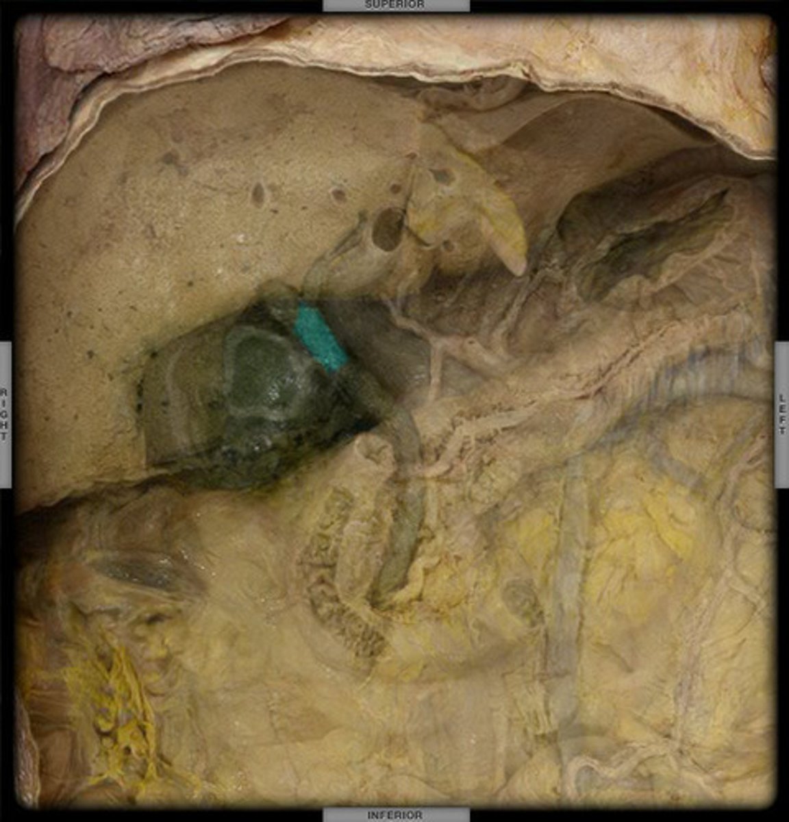 <p>large bile duct leading from liver; joins with the cystic duct to form the common bile duct, formed by the union of the right and left hepatic ducts; the duct through which bile from the liver moves to the cystic and common bile ducts</p>