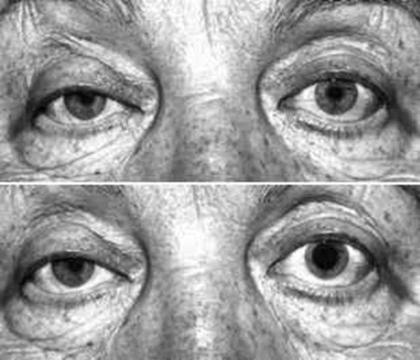 <p>before cocaine OU = anisocoria greater in dim illumination, OD reverse ptosis</p><p>after cocaine OU = normal OS dilates, abnormal OD remains the same size = anisocoria change >1mm present = positive test</p>