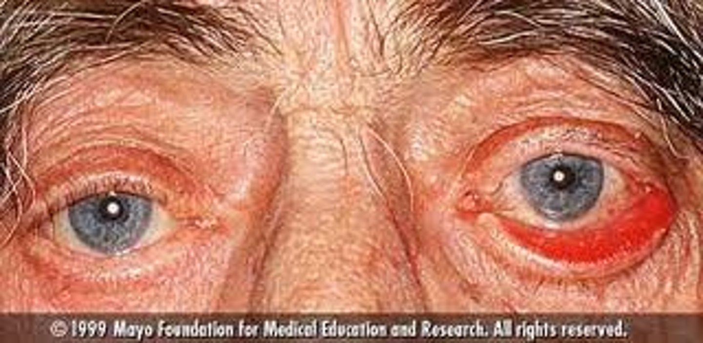 <p>Ectropion occurs with eversion (turning inside out) of the lower eyelid exposing the palpebral conjunctiva</p>