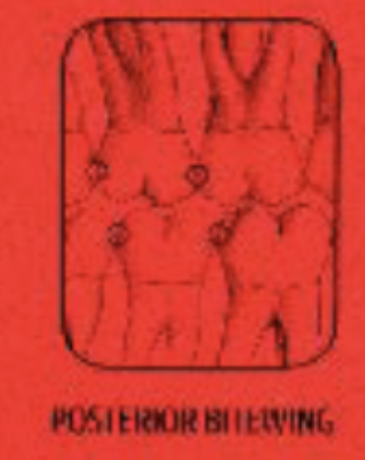 <p>-Between the first furcation (where the roots divide) of the 3rd molar and half the 2nd premolar</p>
