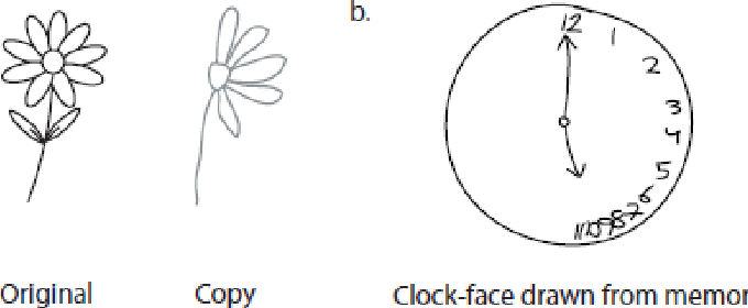 <p>Neuropsychological: <strong>Unilateral Neglect</strong></p>