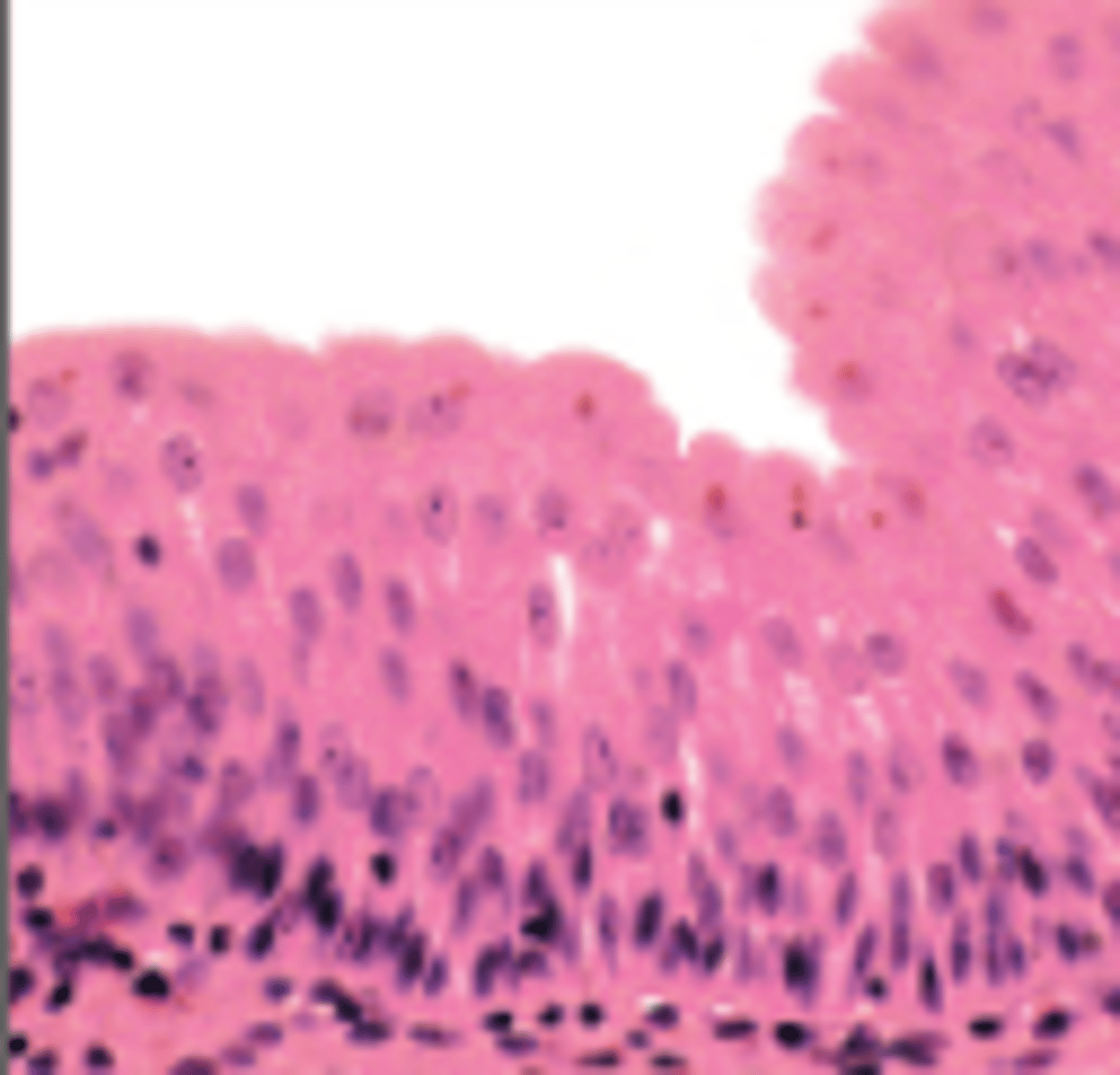 <p>Limited to urinary tract</p>