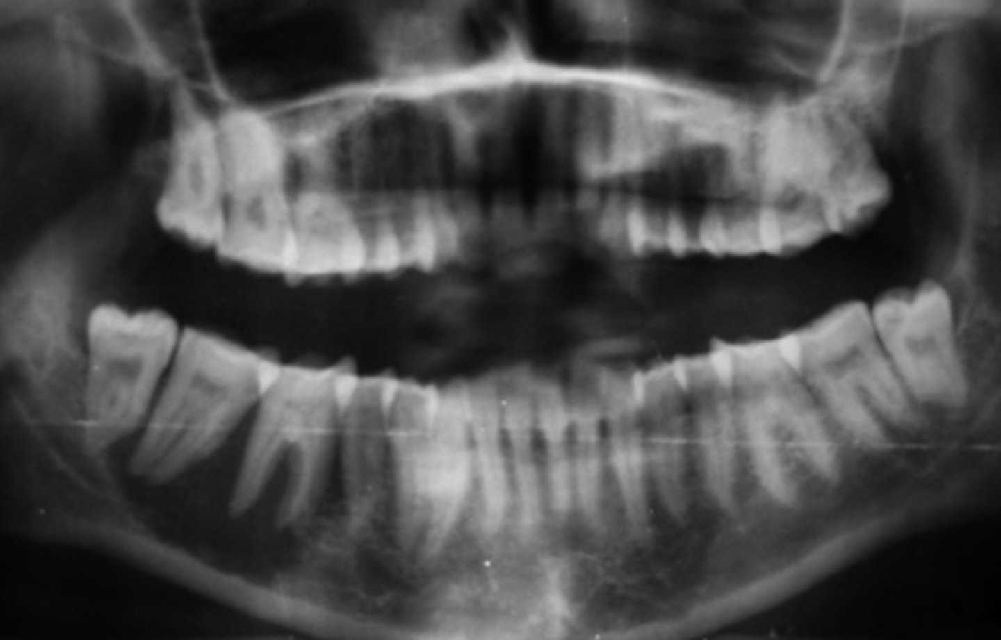 <p>patient's radiograph shows, defined radiolucent lesion on the posterior mandible. IAN canal appears destroyed. Posterior teeth appear to be "floating" due to bone destruction.There is sudden mobility of #30, 31 for 1 month. There is no clinical evidence of peridontal disease. Patient experiences a dull ache. What is the diangosis?</p>