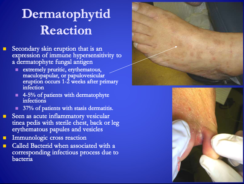 <p><span><strong>[...]</strong></span></p><ul><li><p>Secondary skin eruption that is an expression of immune hypersensitivity to a dermatophyte fungal antigen<br></p><ul><li><p>extremely pruritic, erythematous, maculopapular, or papulovesicular eruption occurs 1-2 weeks <span>after</span> primary infection</p></li><li><p>4-5% of patients with dermatophyte infections</p></li><li><p>37% of patients with stasis dermatitis&nbsp;</p></li></ul></li></ul><p></p>