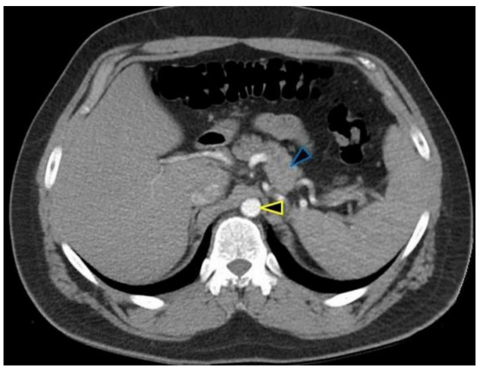 <p>A CT scan from a 55-year-old male reveals the result shown in the accompanying image. What structure is indicated by the yellow arrowhead?</p><p>A. Aorta</p><p>B. Duodenum</p><p>C. Inferior vena cava</p><p>D. Lumbar lymph node</p><p>E. Superior mesenteric artery</p>
