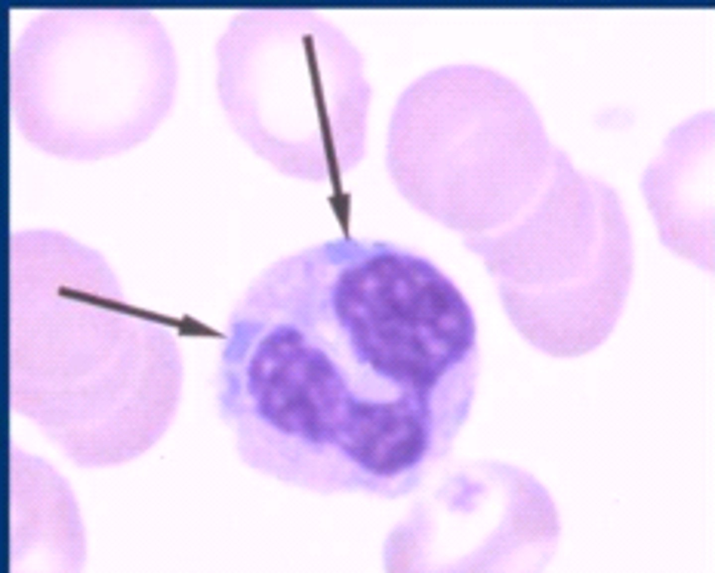 <p>Toxic changes in neutrophils</p><p>-round to linear blue aggregates in the cytoplasm</p>