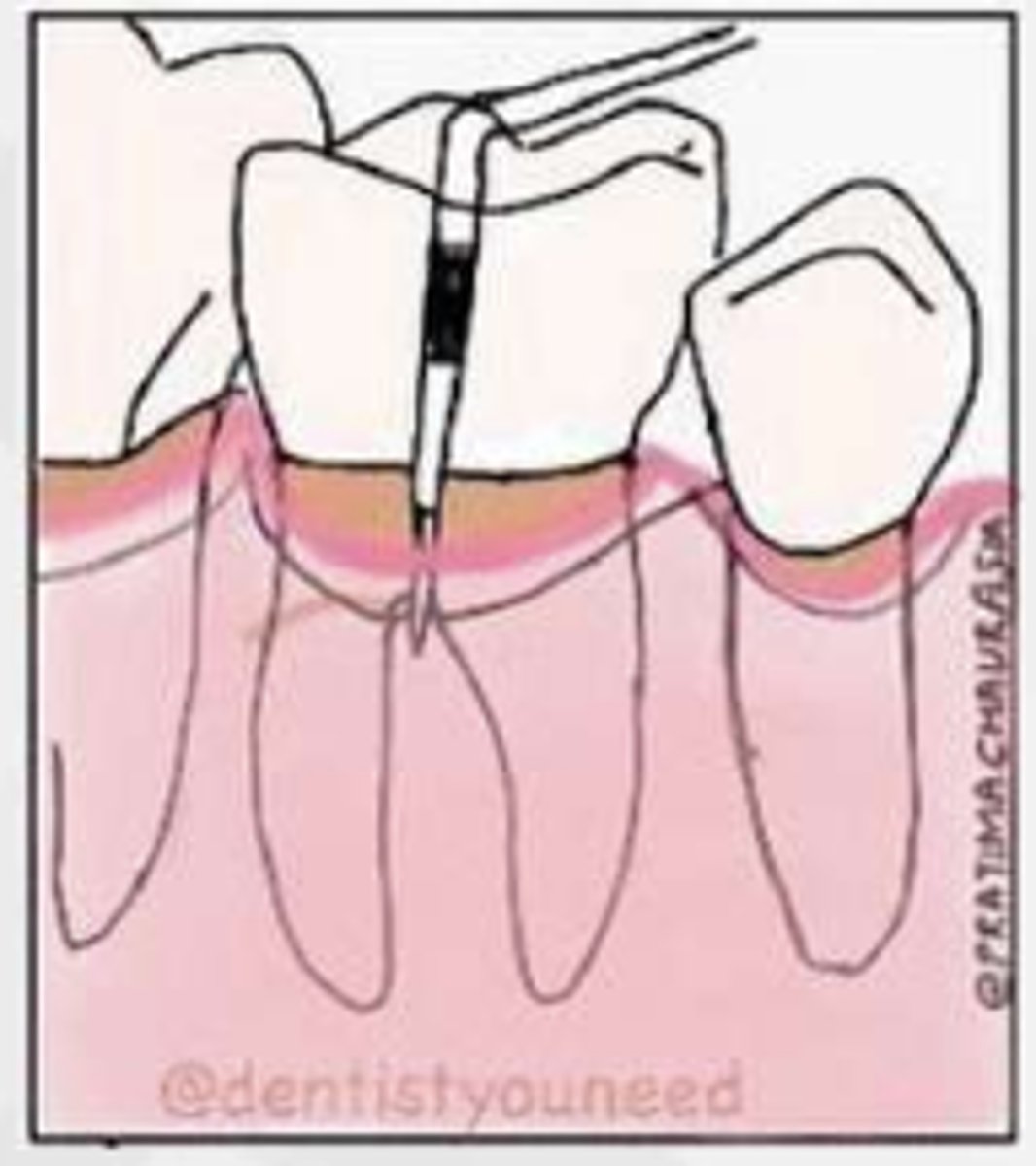 <p>Pocket into flute, but intact interradicular bone</p>
