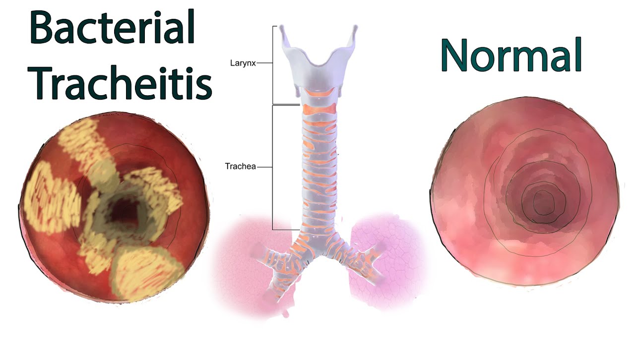 <p>An <strong>infection or inflammation of the trachea</strong>, often caused by <strong>bacteria</strong> following a viral upper respiratory infection (<em>e.g.</em>, <strong><em>S. aureus</em></strong>) or irritants like chlorine gas, sulfur dioxide, and smoke, which damage the tracheal lining.</p>