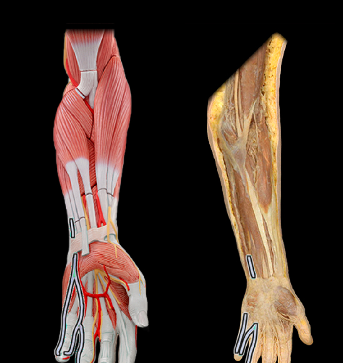 <p>ulnar n.&nbsp;</p>