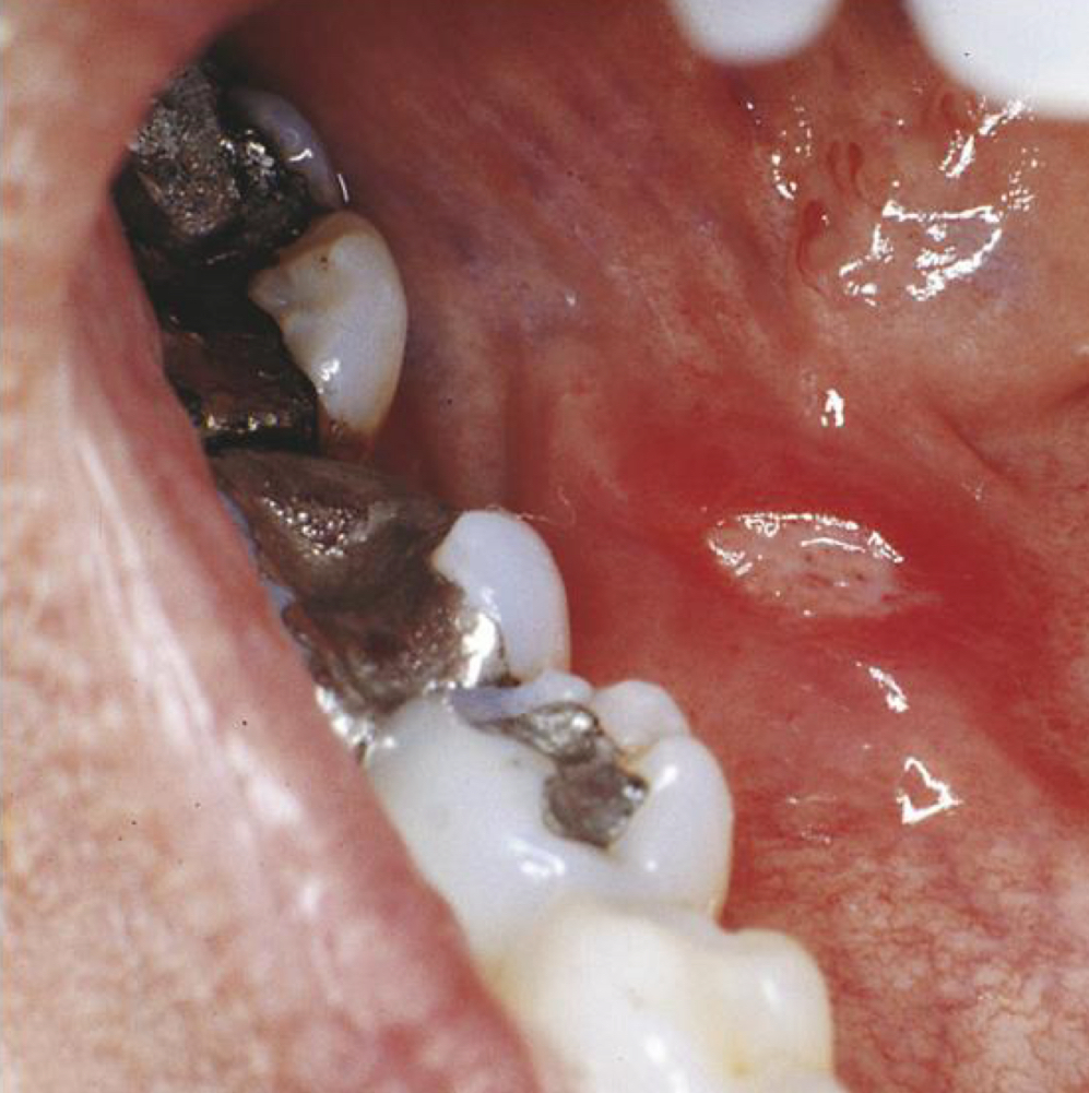 <p>Aphthous ulcers&nbsp;</p>