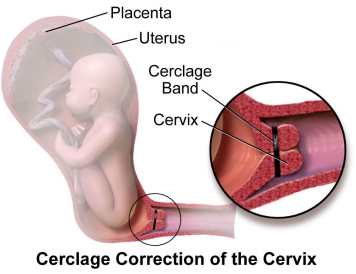 <p><strong>Managing Patient with a History of Preterm Birth</strong></p><p>-Serial cervical _______ screening every _ weeks from 16-24 weeks </p><p>-Offer ___________ supplementation if cervical __________ noted </p><ul><li><p>Endometrin → vaginal progesterone </p></li></ul><p>-Consider cervical ________</p><p></p>