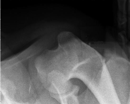 <p>what radiographic view of the shoulder is shown?</p>
