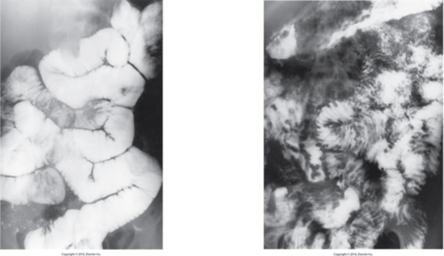 <p><strong>What is Whipple disease?</strong></p>