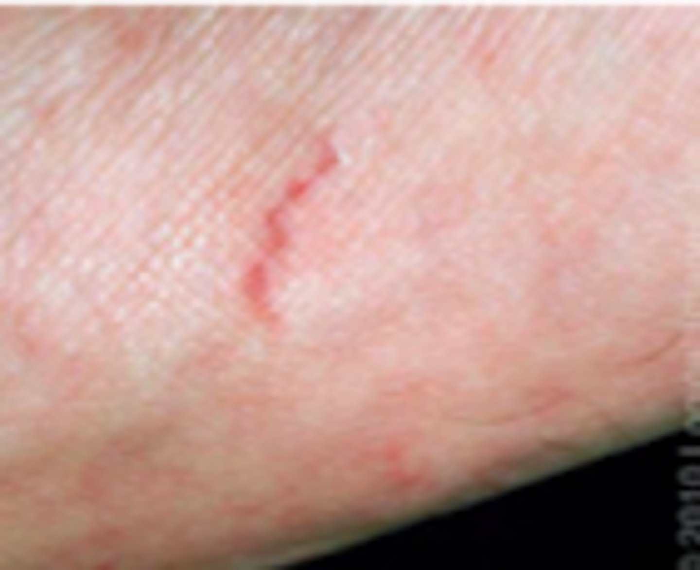 <p>Parasitic ID:</p><p>Overview:</p><p>- Common infestation of the skin by the mite Sarcoptes scabiei</p><p>- Particularly common in resource-limited regions</p><p>- Crowded condition increase risk for scabies infestation</p><p>- Transmission usually occurs through direct and prolonged skin-to-skin contact</p><p>- May occur among family members or sexual partners; casual skin contact is unlikely to result in transmission</p><p>- Fomite (clothing , bedclothes, other objects) transmission is uncommon, but more likely to occur in the setting of crusted scabies due to a much higher parasite burden</p>