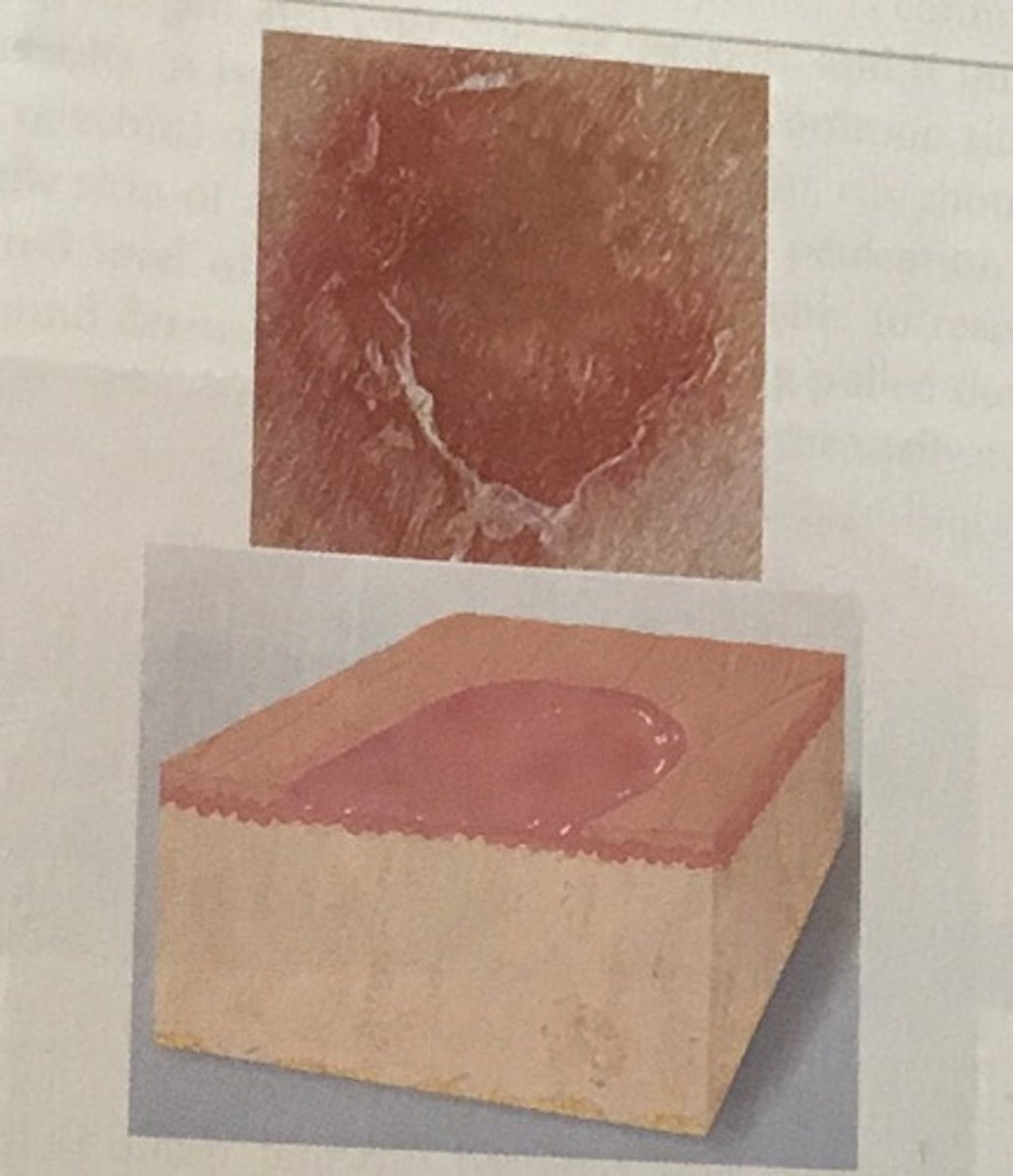 <p>Scooped out but shallow depression. Superficial; epidermis lost; moist but no bleeding; heals without scar because erosion does not extend into dermis.</p>