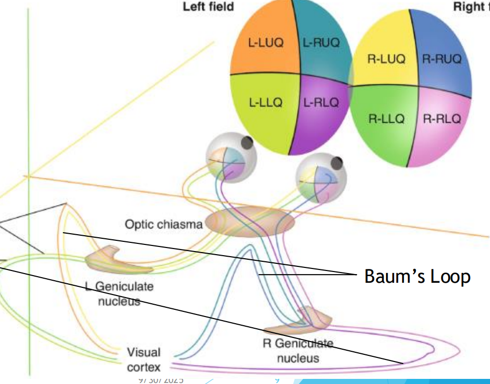 <p>Made up of superior fibers of the retina (Process inferior visual field)</p><p>As they pass through <u>parietal lobe</u>, they form<strong> baums loop</strong></p>