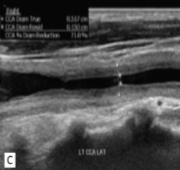 <p>This was seen at the patient’s aorta.&nbsp;</p><ol><li><p>How does it appear sonographically?</p></li><li><p>What pathology can be assumed here?</p></li></ol><p></p>