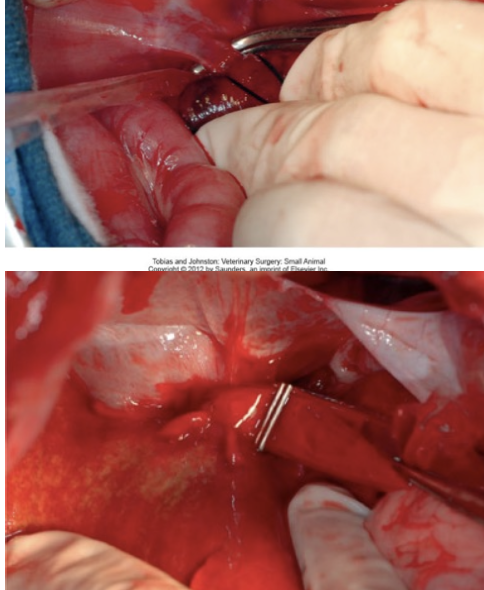 <p>- Folded piece of cellophane which is secured with hemoclips</p><p>- Fibrous tissue reaction</p><p>- Gradual occlusion</p>