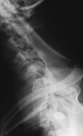 <p>What is this x-ray demonstrating?</p>
