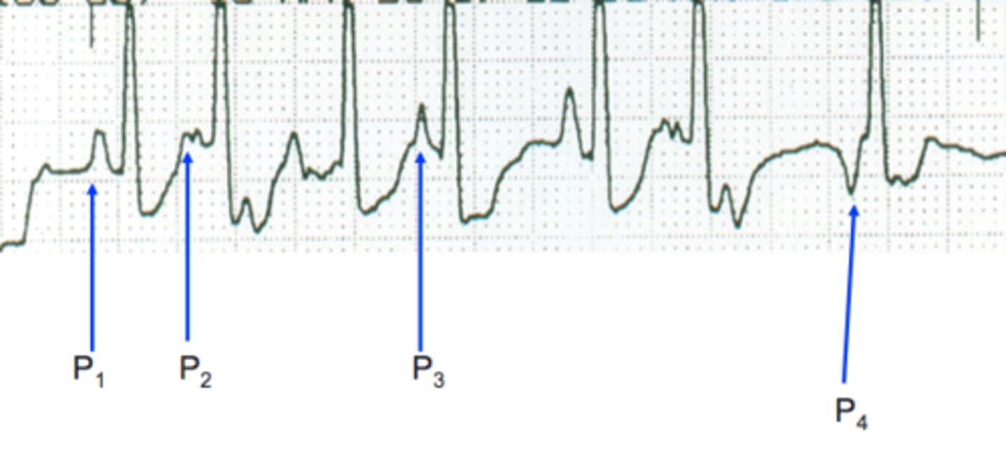 <p>3 or more varying P-Waves, overall irregular and rate is >100 ppm. Note the DIFFERENT P’s presented.</p>