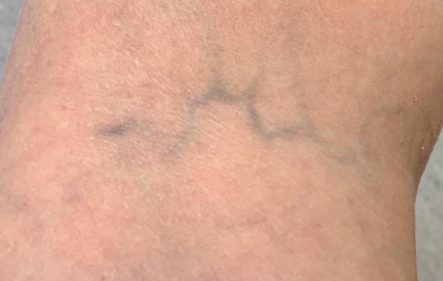 <p>Smaller than varicose veins, larger than spider veins</p>