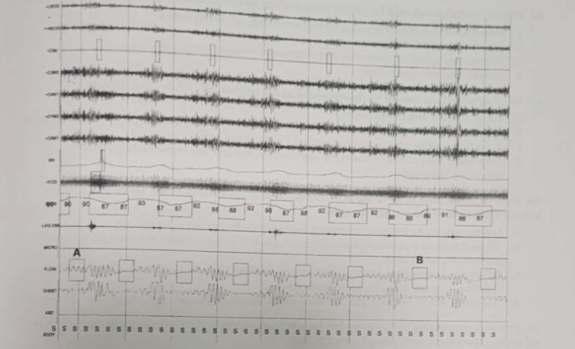 <p><span>What sort of respiratory event is seen in the box marked B?</span></p>