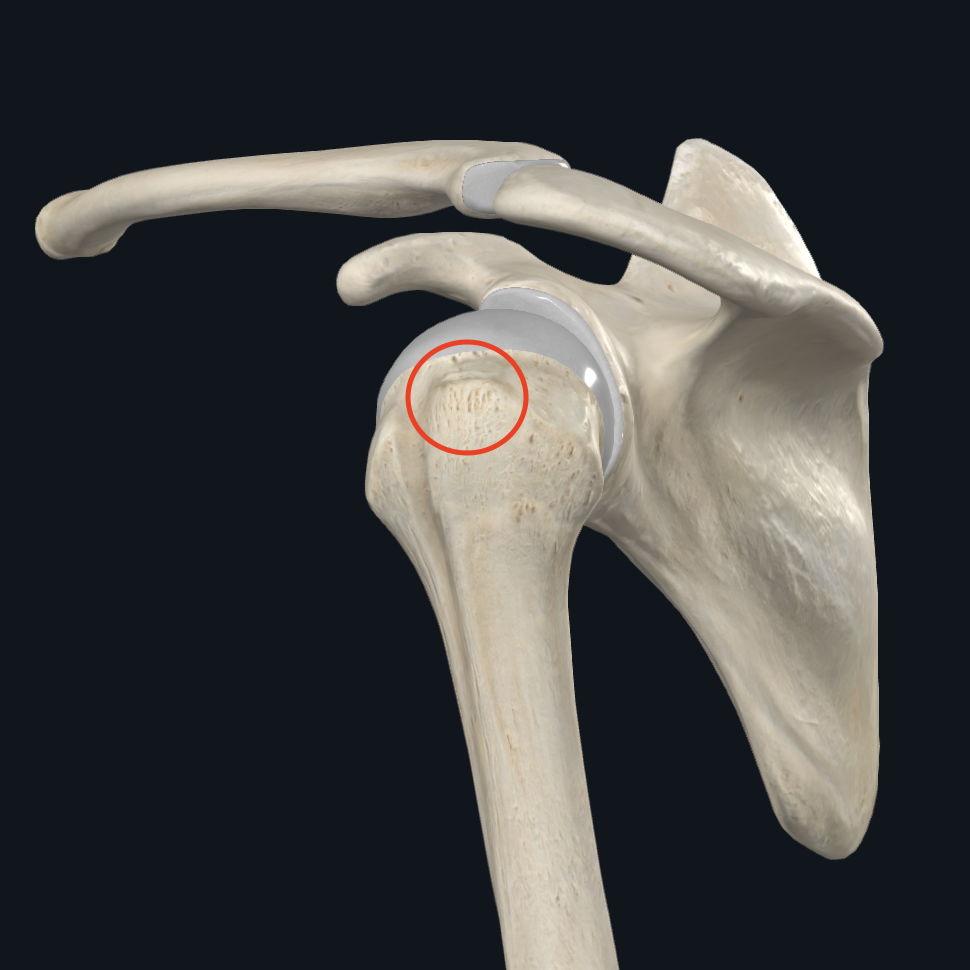 <p>Quel muscle se fixe sur la partie supérieure du <strong><em>tuberculus majus humeri</em></strong> (partie <strong><em>supérieure</em></strong> du grand tubercule de l’humérus) ?</p>