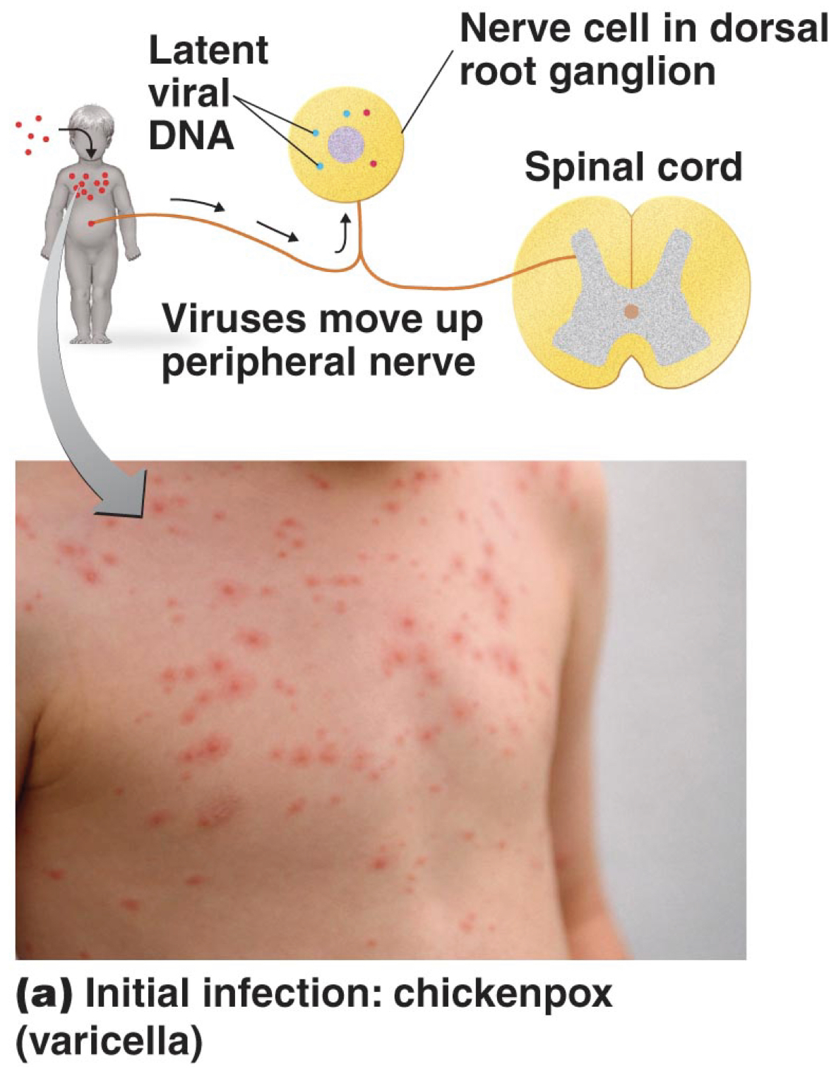 * Varicella-zoster virus (HHV-3) 
* Transmitted by the respiratory route 
* Causes pus-filled vesicles 
* Virus may remain latent in dorsal root ganglia 
* Prevention: Live attenuated vaccine 

\
