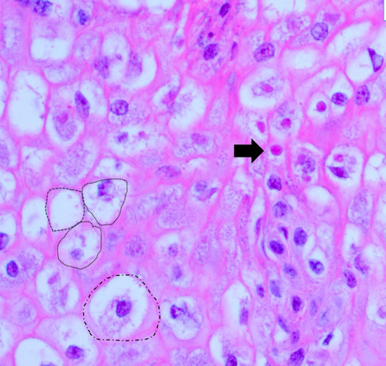 <p>identify the vacuolar degeneration of the of the oral cavity?</p>