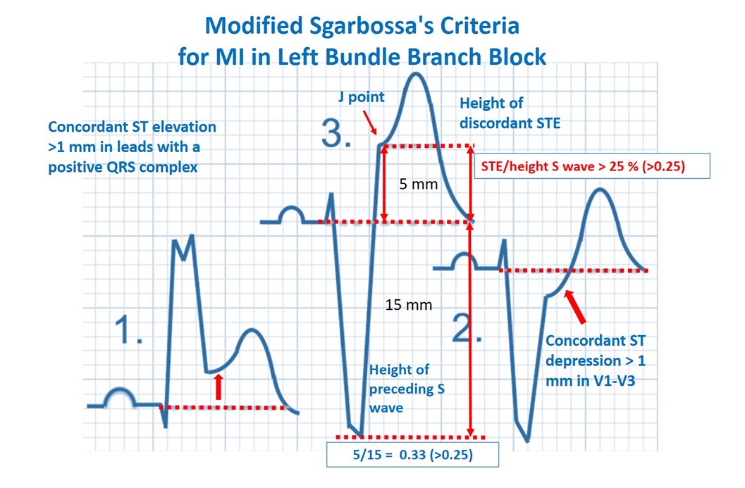 <p><strong>Original Sgarbossa Criteria: </strong></p><p>Positive finding in any criteria is suggest OMI</p><ol><li><p class="">Concordant ST elevation ≥1 mm in leads with a positive QRS (5 points)</p></li><li><p class="">Concordant ST depression ≥1 mm in V1–V3 (3 points)</p></li><li><p>ST Elevation at the J-point, relative to QRS onset, is at least 1 mm AND has an amplitude at least 25% of the preceding S-wave</p><p><em>An ST/S ratio of 0.20 is also very high and almost as specific as a 0.25 ratio</em></p></li></ol><p></p>