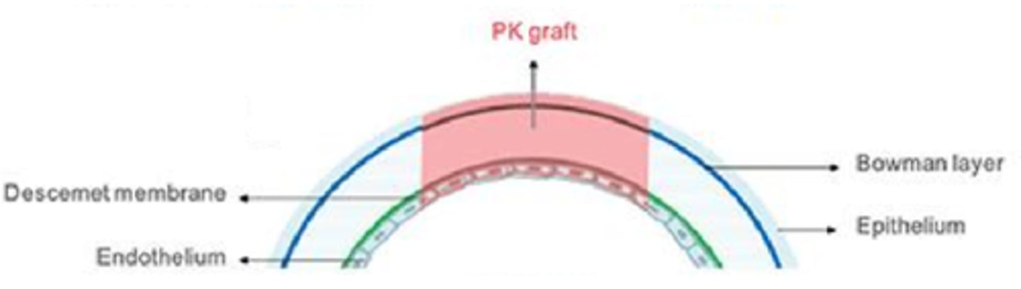 <p>What is a penetrating keratoplasty (PKP)?</p>