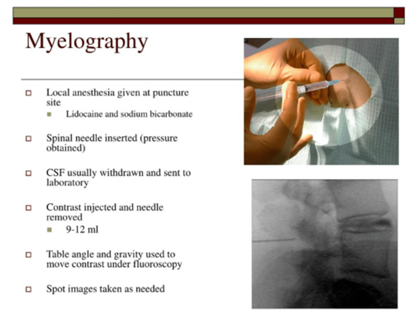 <p>spinal stenosis, disc herniation, spondylosis, arthritis</p>