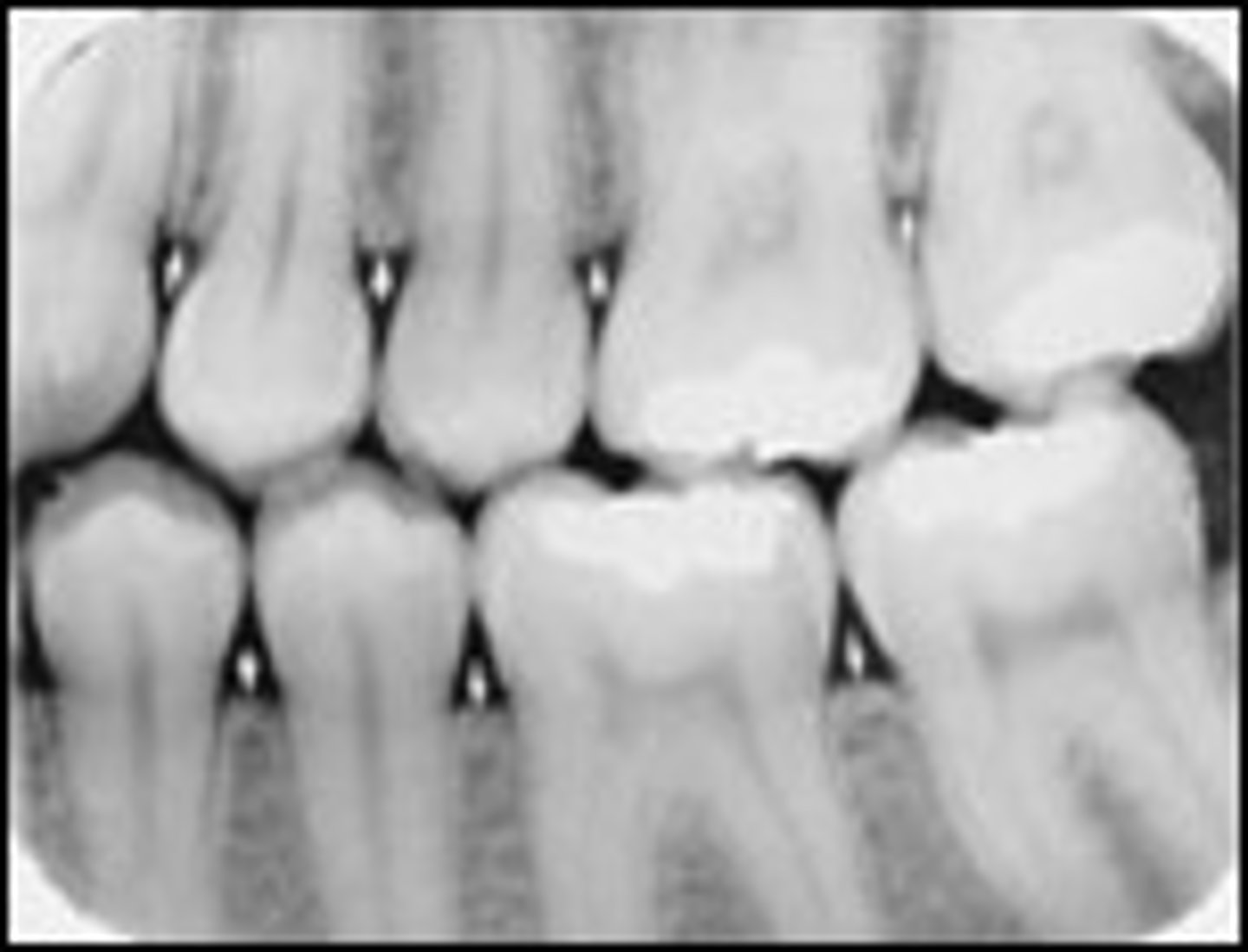 <p>What is the radiopaque structure seen here?</p>