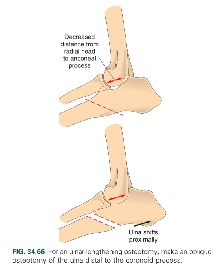 <ol><li><p>Transverse or short oblique osteotomy of proximal ulna and pin placement </p></li><li><p>Short oblique osteotomy of distal third of the ulna</p></li><li><p>Biplanar long oblique osteotomy of ulna </p></li></ol><p></p>