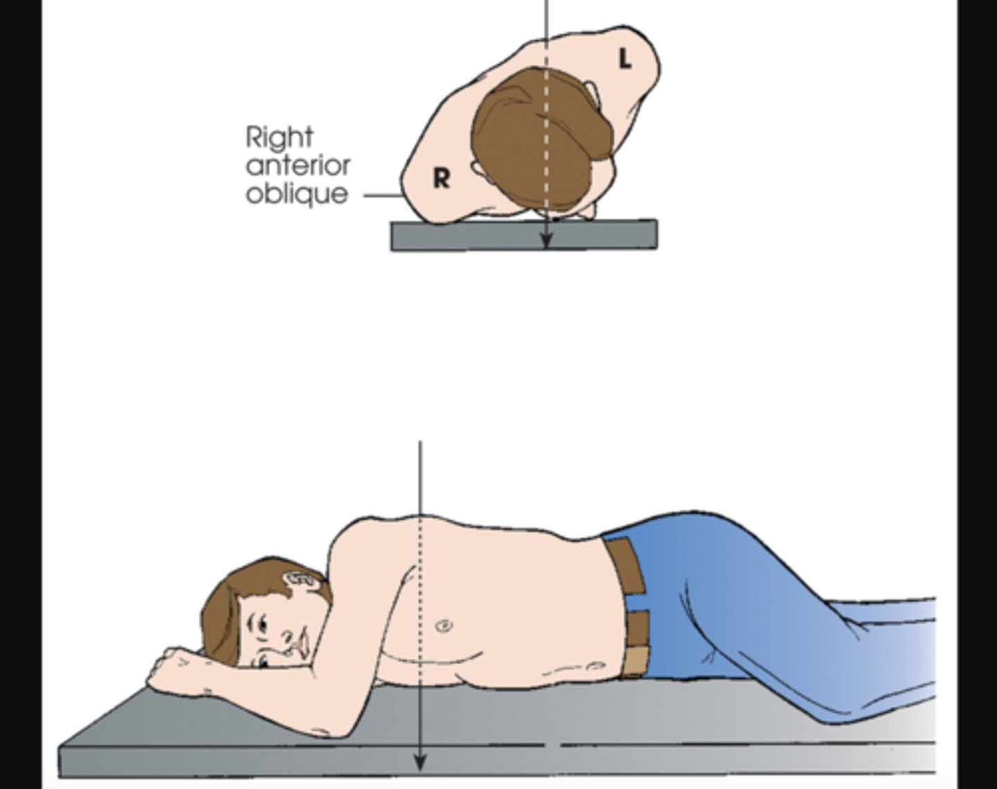 <p>X radiographic position of chest results in PA oblique projection</p>