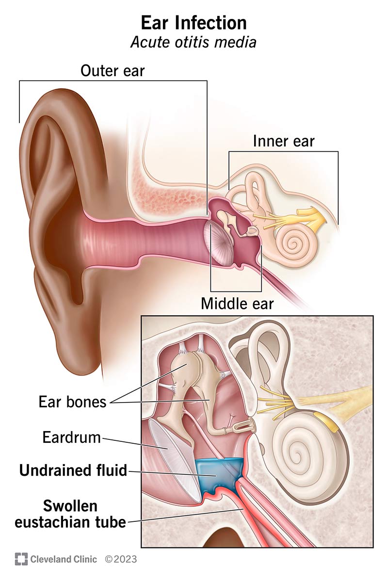 <p>An ear<strong> </strong>infection or <strong>inflammation of the middle ear</strong>, the space behind the eardrum. It often occurs when the Eustachian tube, which connects the middle ear to the back of the throat, becomes blocked. </p>