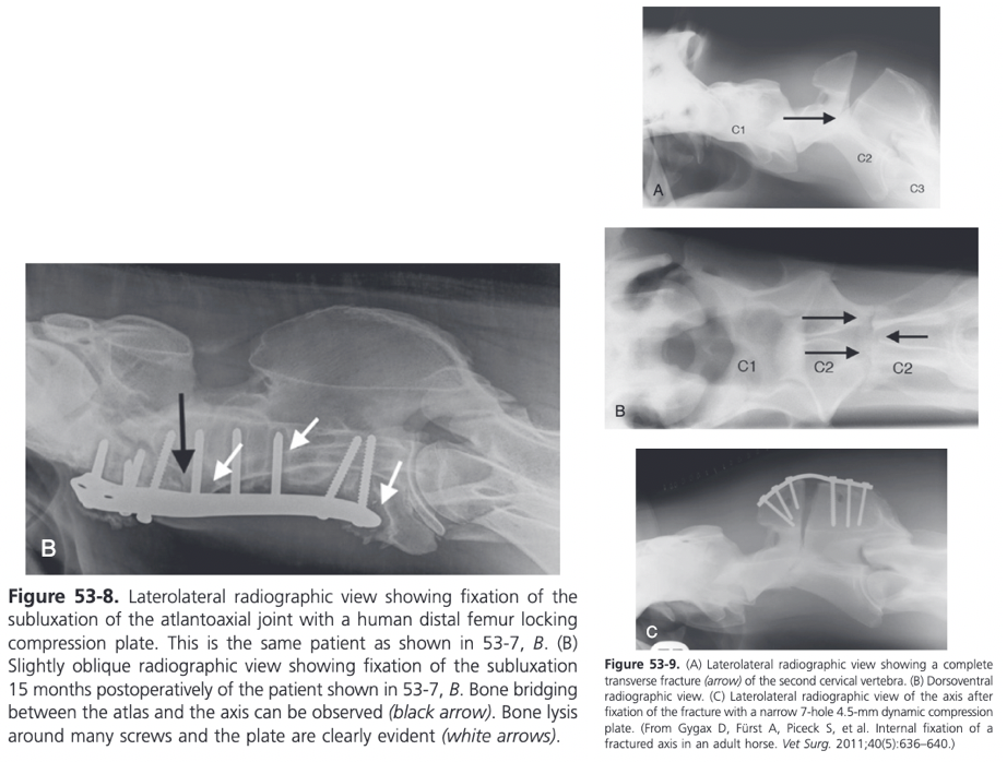 <ul><li><p><span>Surgical repair is warranted if clinical signs deteriorate, preferably before the foal becomes recumbent, or if the foal is valuable or intended for athletic competition</span></p><ul><li><p><span>Surgical techniques include dorsal laminectomy of the caudal atlas as well as external fixation using Steinmann pins, and ventral atlantoaxial fusion through compression plating</span></p></li></ul></li><li><p><span>Both ventral and dorsal approaches to a fractured axis have been described</span></p></li><li><p><span>Dorsal laminectomy of the caudal half to two-thirds of the dorsal arch of the atlas can relieve the spinal cord compression created by a fracture callus and may result in a long term improvement in the neurologic status of the horse</span></p></li><li><p><span>When using a ventral approach, a 30 cm midline ventral skin incision centered on the affected vertebra is performed</span></p><ul><li><p><span>Ventral spinous process of the body of the axis is flattened slightly using a curved osteotome and bone rongeur</span></p></li><li><p><span>After exposing the ventral surfaces of the atlas and axis, the alignment of the vertebrae is corrected and maintained with bone holding forceps</span></p></li><li><p><span>Use of an LCP is preferred</span></p></li><li><p><span>Narrow or broad 3.5/4.0 mm or 4.5/5.0 mm LCP can be used depending on patient size</span></p></li><li><p><span>Plate contoured to improve soft tissue closure over the plate</span></p></li><li><p><span>Plate is applied to the ventral aspect of C2 and one cortex screw is inserted into each fragment in load fashion</span></p></li><li><p><span>Remaining holes are filled with locking head screws</span></p></li></ul></li></ul><ul><li><p><span>Ventral stabilization of the atlantoaxial junction by inserting two 6.5 mm cancellous screws across the articulation after removal of cartilage from the articular surface has been described</span></p><ul><li><p><span>Care must be taken during drilling of the screw holes in the vertebral arches of the atlas to avoid penetration of the spinal canal axially and the vertebral arteries and first cervical nerves abaxially</span></p></li></ul></li><li><p><span>Various arrangements of Steinmann pins and variations in the application of a Kirschner apparatus in a through-and-through pattern have been reported</span></p></li><li><p><span>Four pins placed through the vertebral bodies of the atlas and axis anchoring the dens with one pin and securing the pins with plates at the skin surface have been used</span></p></li></ul><ul><li><p><span>Fractures of the body of C2 are rare and in selected cases fixation of the fracture can be achieved through compression plate fixation of the dorsal spinous process</span></p></li></ul>