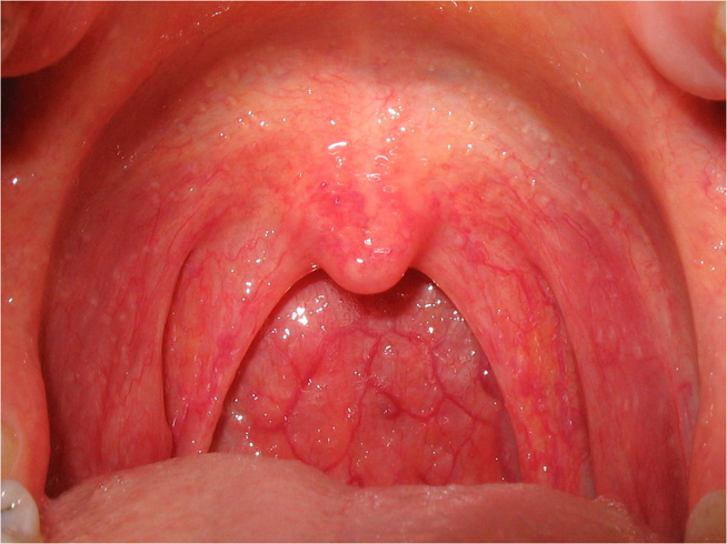 <p>What could be the potential causes of a patient's symptoms, including a temperature of 37.8°C, 5 days since onset of pain, and a dry cough?</p><p><mark data-color="green">Lecture Slide 17</mark></p>