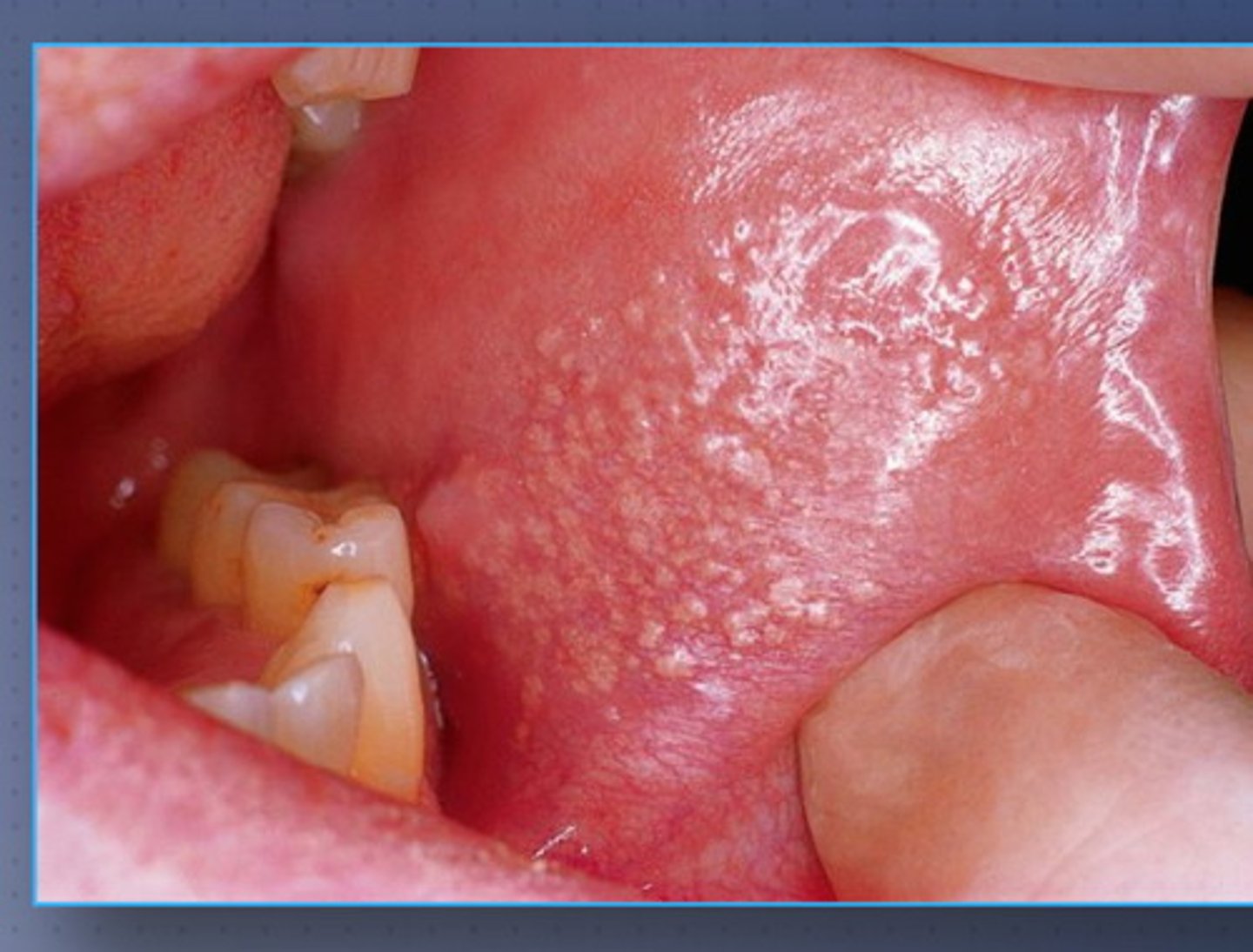 <p>yellow</p><p>buccal</p><p>sebaceous glands</p>